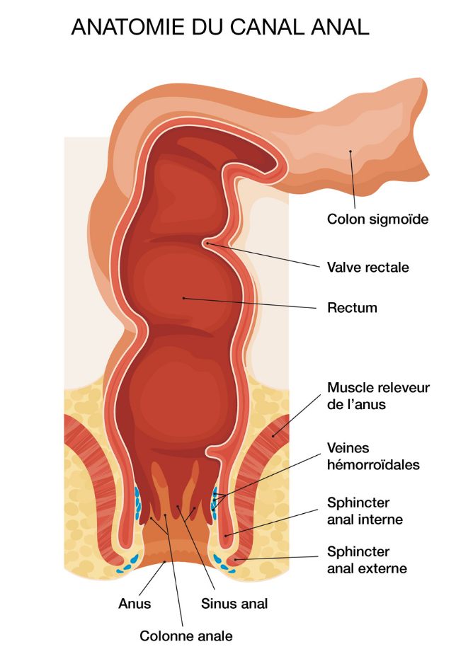 Les hémorroïdes internes et externes - Sedorrhoide
