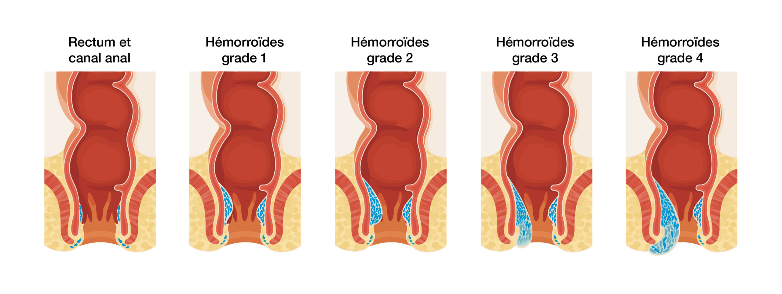 Quand parler de crise hémorroïdaire ? - Sedorrhoide