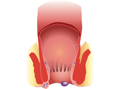 Les hémorroïdes internes et externes - Sedorrhoide
