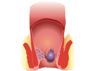 Les hémorroïdes, qu'est-ce que c'est ?